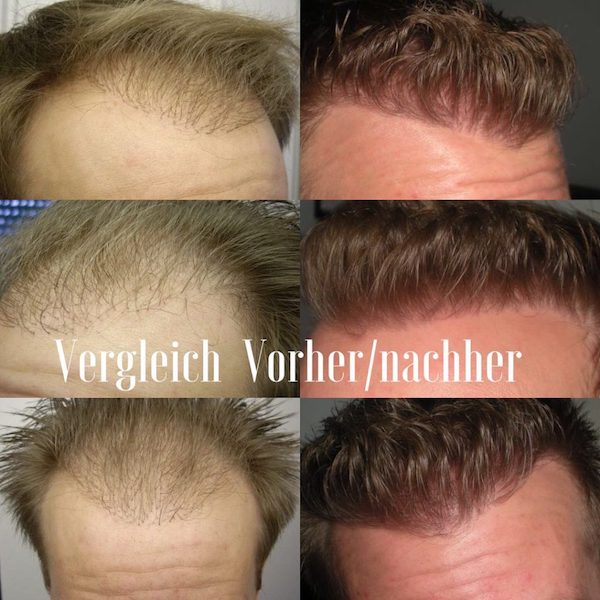 Haartransplantation Korrektur Repair Haarlinie negative vs gute Erfahrungen vergleich Fall Marco