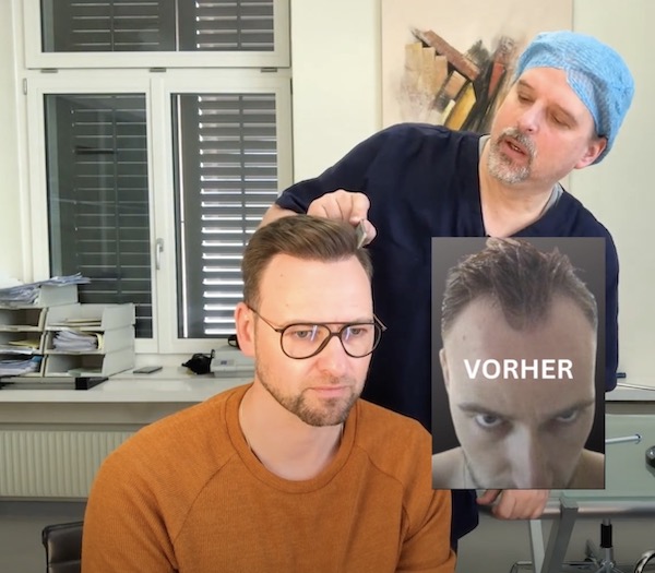 Haartransplantation persönliche Betreuung durch Dr. Lars Heitmann: Patient J. Hansen Resultat-Kontrolle und Beratung
