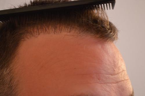 Haartransplantation Pfusch Stefan vor der Korrektur (Repair) von links