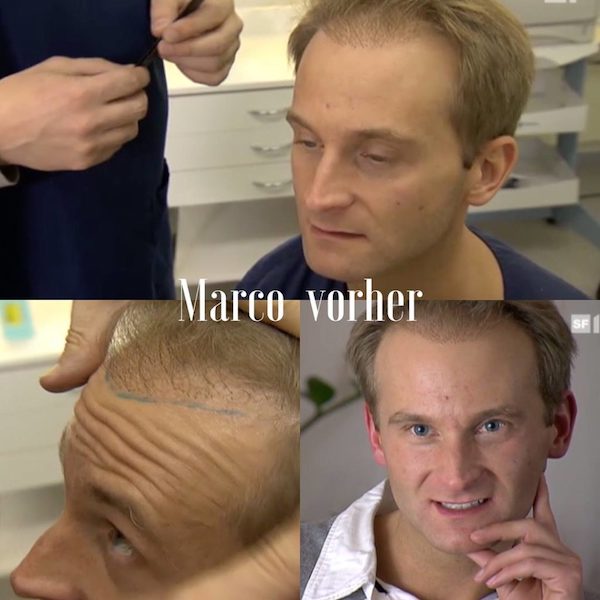 Marco vor der Korrektur FUE Haartransplantation bei Dr. Heitmann