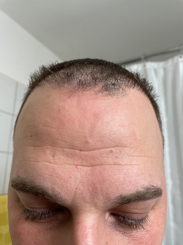 Stefans Haartransplantation Pfusch Resultat