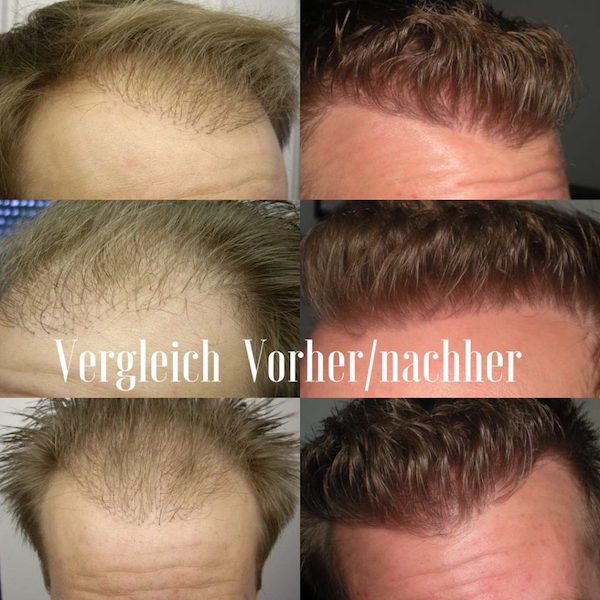 Misslungene Haartransplantation, Risiken und Korrektur