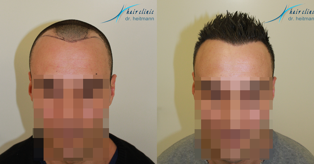 Haartransplantation der Geheimratsecken 