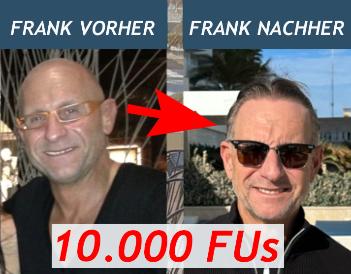 Haartransplantation mit FUE & 10.000 Grafts auf eine Glatze - Frank