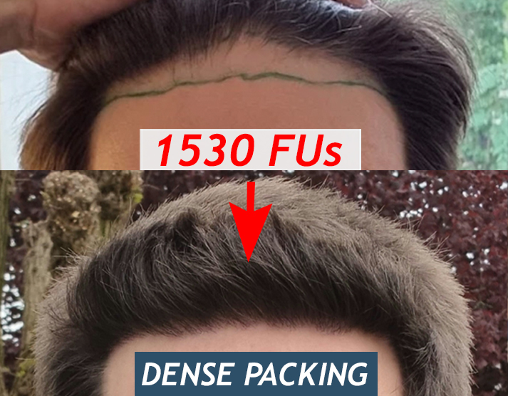 Haartransplantation Resultat Dense Packing 1530 Grafts 