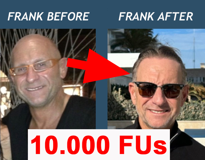 Hair Transplant 10.000 Grafts on bald head FUE Patient Frank