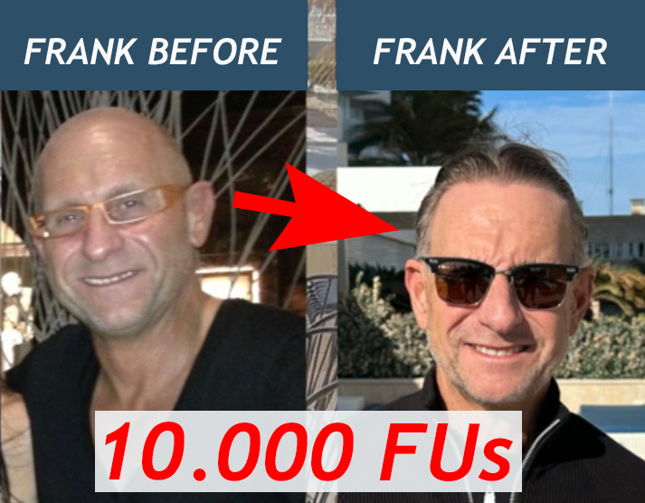 Hair Transplant 10.000 Grafts on bald head FUE Patient Frank Hair Transplant 10.000 Grafts on bald head FUE Patient Frank
